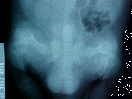 Pelvic X-ray showing poor bone density