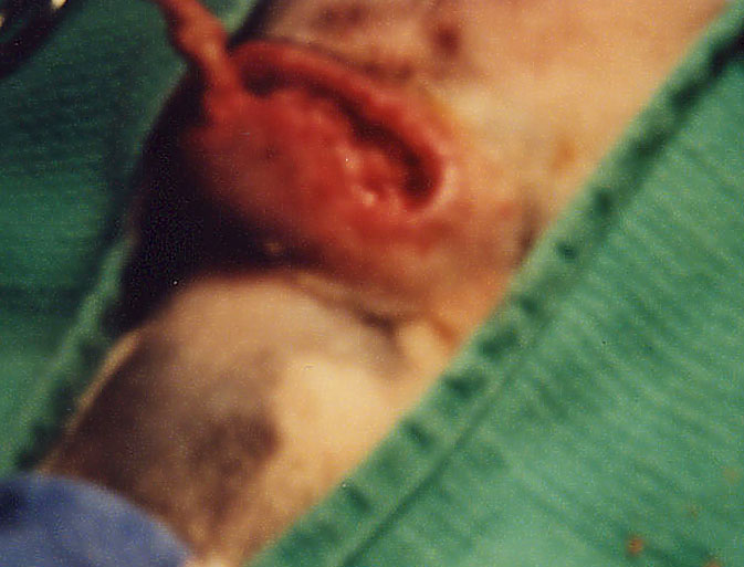 Removing infected tissue from the bite area