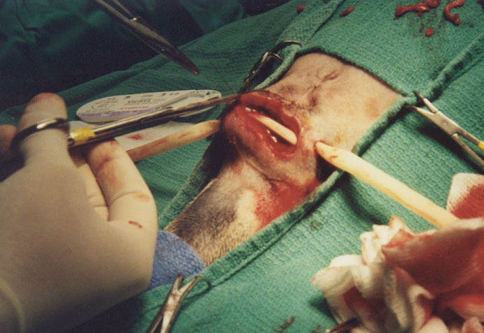 Closing the incision with drain in place