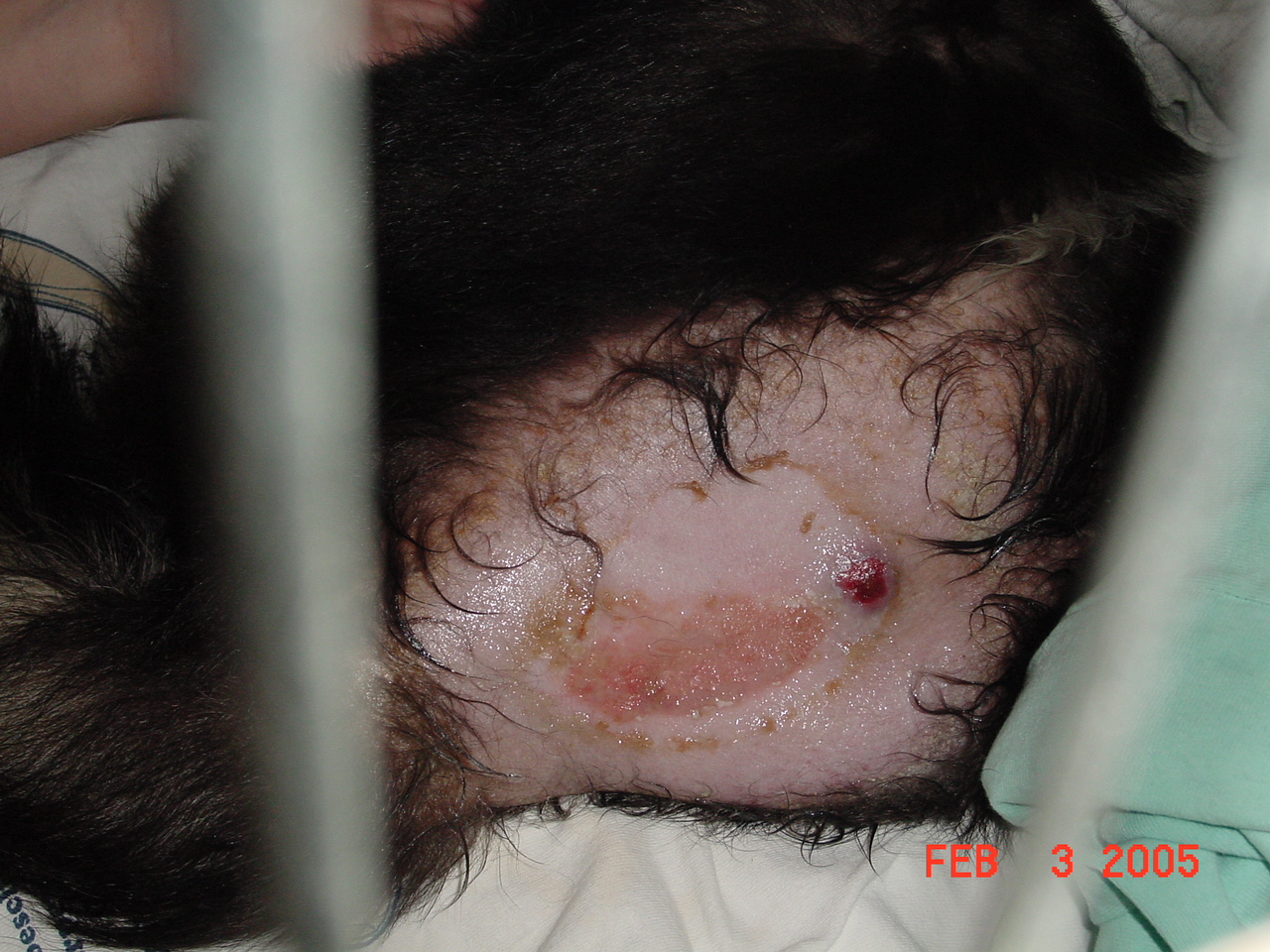 Severe abrasion, hair loss, and open wound from staph infection